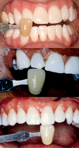 KoR results of Tooth-whitening treatment